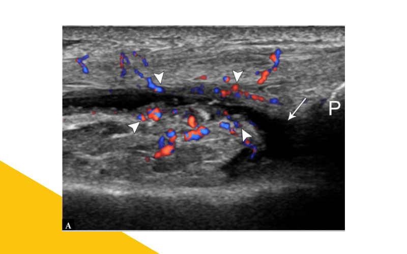 2. Evaluacion rodilla ecografia.png